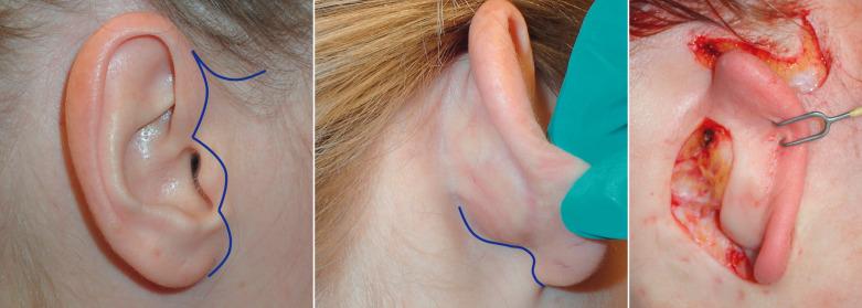 Fig. 8.3, This image shows the incision markings and actual incision in a short scar type facelift.