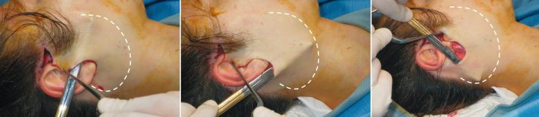 Fig. 8.4, This image shows the anterior, inferior, and posterior limits of a typical short scar (“weekend”) facelift dissection.