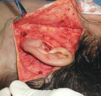 Fig. 8.5, This image shows the dissection completed on a typical short scar facelift. This particular case has a generous posterior auricular dissection because many short scar lifts have a posterior auricular incision, which terminates in the mastoid region as shown in Fig. 8.14 .