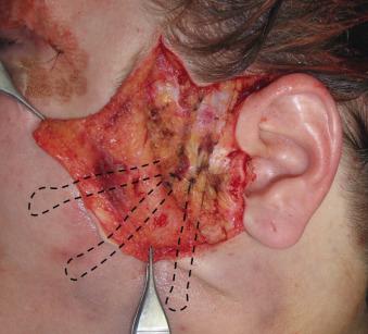 Fig. 8.6, This image shows a superficial muscular aponeurotic system plication in a short scar facelift. The plication sutures are diagramed to show their placement, extension, and vectors.