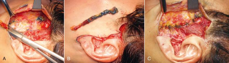 Fig. 8.7, Even though the shortscar facelift technique uses smaller dissection than conventional lift, a small superficial muscular aponeurotic system (SMAS)-ectomy is still an option. The left image (A) shows the SMAS strip being excised, the middle image (B)shows the SMAS strip overlying its approximate position, and the right image (C) shows the final SMASectomy sutures.