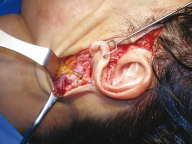 Fig. 8.8, This image shows a solitary suture securing deep tissues in the area of the posterior platysma to the mastoid fascia.