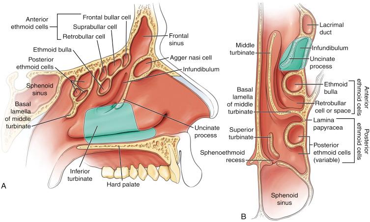 Fig. 15.1, Schematic drawings in sagittal (A) and axial (B) views showing the region removed (shaded area) when a modified medial maxillectomy is performed.