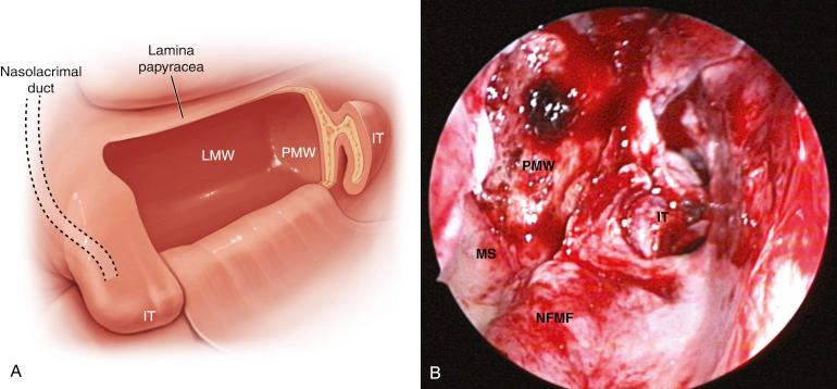 Fig. 15.2, (A) Drawing showing the boundaries of a completed right modified medial maxillectomy. Dashed line represents the course of the nasolacrimal duct within the medial maxillary wall. The posterior boundary is the posterior maxillary wall (PMW). The superior boundary is the lamina papyracea. The inferior boundary is the maxillary sinus floor. The medial boundary is the inferior turbinate (IT) and nasal floor. The lateral boundary is the lateral wall of the maxillary sinus (LMW). (B) Endoscopic image showing a completed modified medial maxillectomy. MS, Maxillary sinus wall; NFMF, nasal floor mucosal flap.