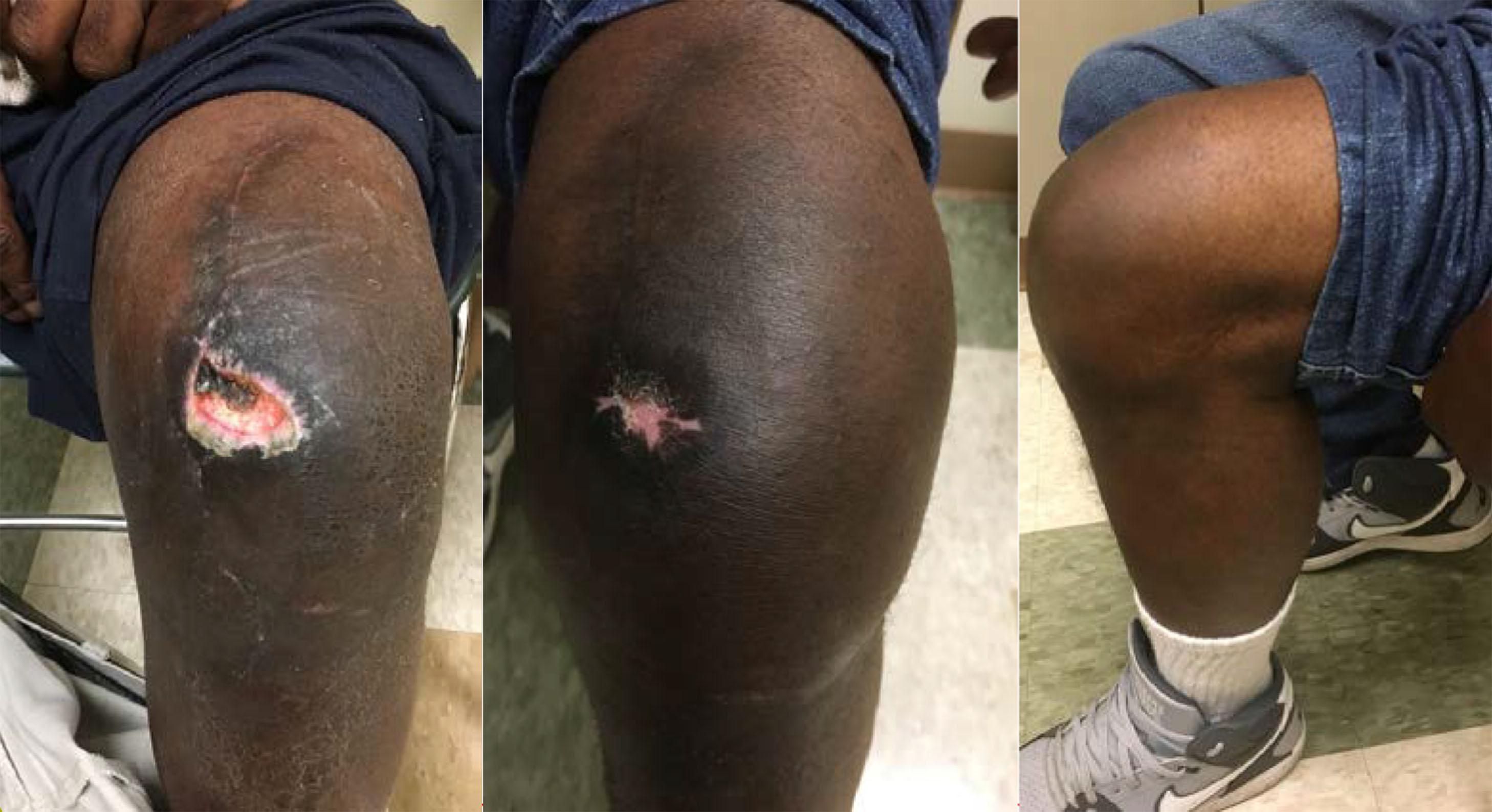 Fig. 2.1, A 62-year-old smoker underwent a primary total knee arthroplasty (TKA) for posttraumatic arthritis. A previous incision was used, and the patient developed skin necrosis on the lateral aspect of the incision. Plastic surgery recommended silver-impregnated dressings. There was no deep tissue necrosis, and infection workup was negative. The patient went on to heal the necrotic area.