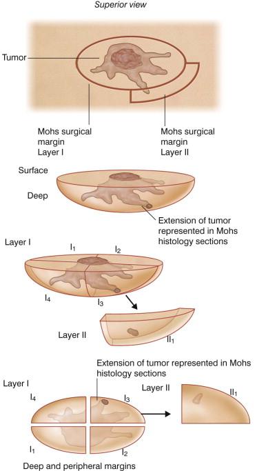 FIGURE 45.2, Mohs micrographic surgery technique.