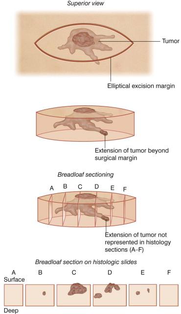 FIGURE 45.3, Limitation of breadloaf method of examining the margin of conventional excision. In this example, excisional tip sections A and F are clear of tumor and sections B, C, D, and E demonstrate tumor. No extension to the peripheral margins is detected, and the excision is technically clear on margins. However, this is not an accurate margin assessment. Extension of tumor to the surgical margin between sections D and E is missed because it is not sampled.