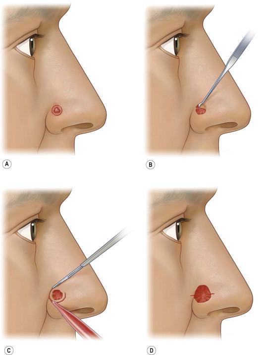 FIGURE 45.4, Preparation and excision. (A) Preoperative view of right nasal alar basal cell carcinoma. (B) Debulking with curette. Tumor debulking may be helpful in delineating subclinical extensions of tumor that are not grossly visible. (C) Stage 1 excision. Note the 30–45° angle of the knife blade and the 2 mm margin of normal-appearing skin around the debulked area. (D) Stage 1 excision completed with specimen removed. Note scoring of epidermis at medial and lateral margins of operative site corresponding to division of specimen into sections appropriate for processing.