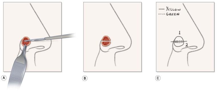 FIGURE 45.6, Mapping and division of the specimen. (A) Division of specimen using scalpel and forceps. Maintenance of orientation is critical to the procedure. (B) Divided specimen showing orientation. (C) Map orienting tissue specimen and denoting dye marking of non-epidermal margins. Note that the map is specific to the anatomic area and whether the tumor is on the left or right.