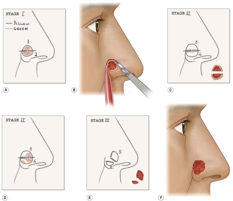 FIGURE 45.10, Stage II and III excision. (A) Residual tumor in the specimen margins noted by coloring the area red on the map. (B) Excision of stage II includes a 2-mm margin of all positive areas. (C) Stage II specimens and map. (D) Residual tumor after stage II noted on map after prepared specimens have been interpreted by the surgeon. (E) Stage III specimens and map. (F) Postoperative defect after stage III.