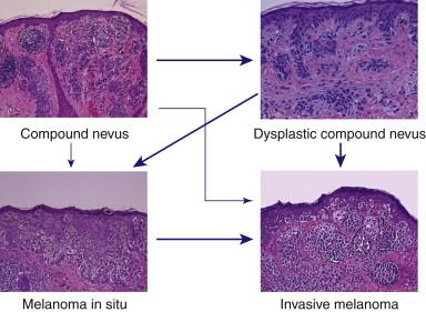 Figure 42-1, Development of melanoma