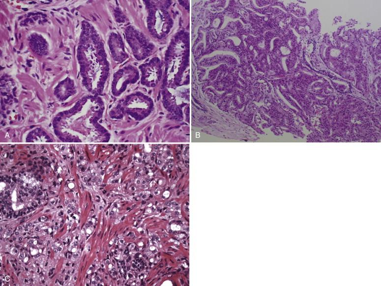 Figure 38-1, Examples of Gleason grade 3, 4, and 5 prostate cancer.