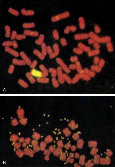 Figure 27-1, A, Homogeneously stained regions and, B, double-minute chromosomes in neuroblastoma.