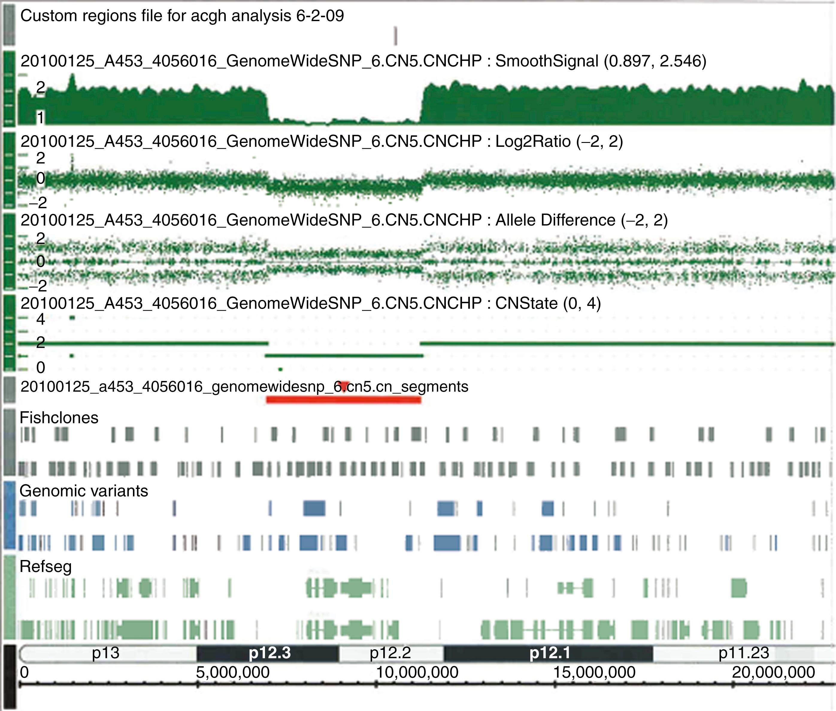 Figure 72.1, Example of a typical deletion result by array comparative hybridization. The gap in hybridization signal demarcated by the red line indicates a 4.329 Mb hemizygous deletion on chromosome 20p12.2-12.3 (6975661–11you 304543 bp). This deletion encompasses multiple genes, including JAG1 , the gene implicated in Alagille syndrome, which was the clinical diagnosis in the tested patient