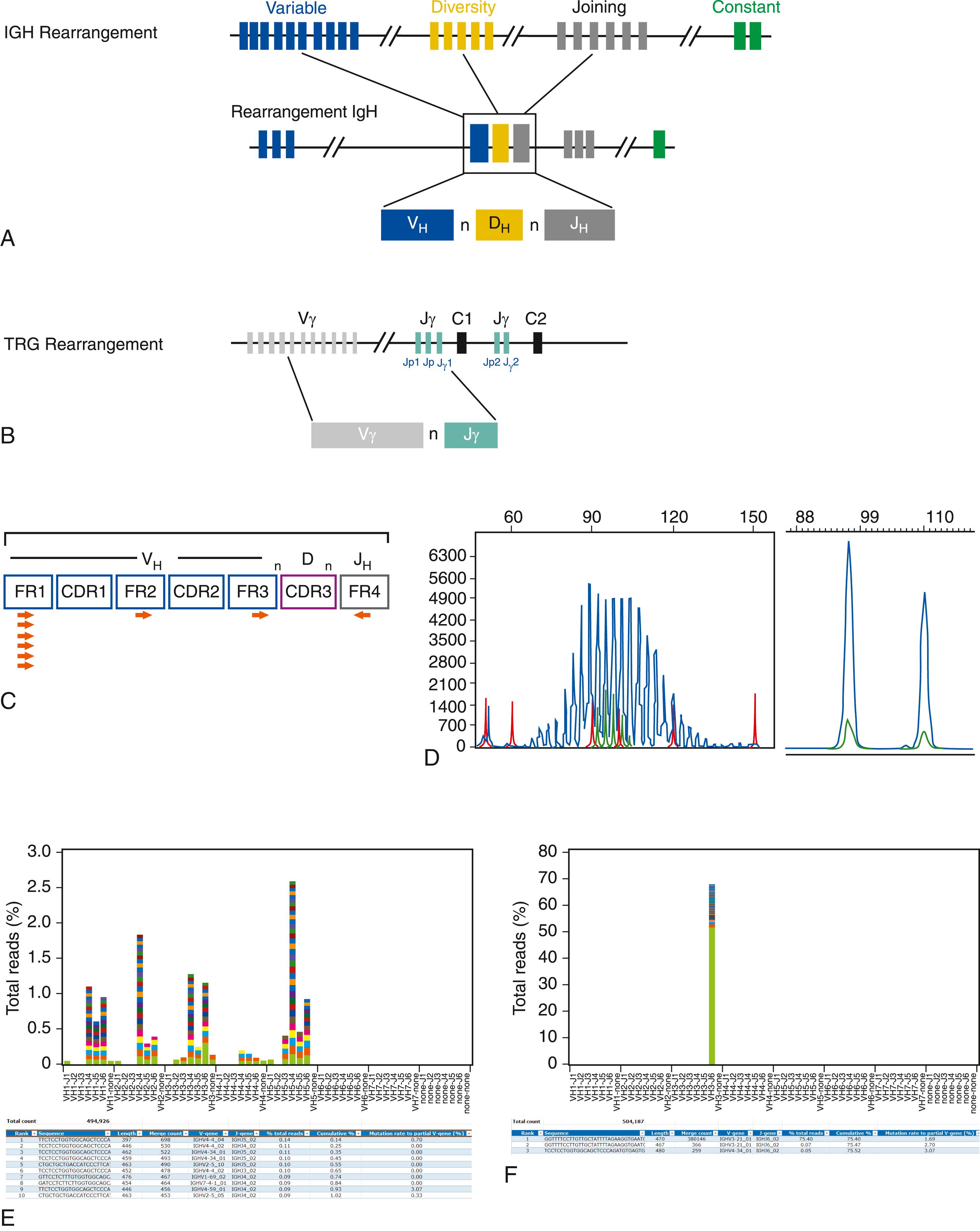 Figure 78.1, Immunoglobulin and T-cell receptor gene rearrangements and determination of clonality in lymphoid proliferations. A, Schematic representation of somatic rearrangements of the immunoglobulin heavy chain ( IGH ) locus (chromosome 14q32) occurring in B-cell development. Selection and rearrangement of IGH diversity (DH) and joining (JH) genes initiates over a large region of intervening DNA followed by the recruitment of a variable region (VH) gene to form a rearranged VDJ coding gene. VH genes can be grouped based on sequence similarities into seven “families.” Substantial immunoglobulin diversity is generated at the nucleotide level because of the large combinatorial selection of the many possible individual V, D, and J genes, as well as by the activity of the enzyme terminal deoxynucleotidyl transferase (TdT), which inserts a random number of “nontemplated” (n) nucleotides at the rearranged junctions. B, The T-cell receptor gamma gene ( TRG ) located at chromosome 7p15 shares similar structural and rearrangement features, with the exception that D genes are not present. The TRG gene is also less complex, having only 11 functional Vγ genes capable of functional rearrangements, along with two sets of J-genes (Jp and Jγ) and two constant (C) regions. C, Detailed schematic of a rearranged IGH gene showing the joined VDJ coding region. The VH gene segment encodes much of the variable component of the immunoglobulin heavy chain peptide. Three relatively conserved framework regions (FR1–3) are identified in the V segment, as well as three more variable sequence “complementary determining regions” (CDR1–3). The CDR3 is composed of the junction between V, D, and J genes, along with inserted nontemplated (n) nucleotides (mediated by the enzyme terminal deoxynucleotidyl transferase [TdT]); this heterogeneous region thus represents a highly unique nucleotide sequence in each B cell. The presence of focal areas of shared sequence homology within the V-gene families (e.g., IGH FR segments) and in the J genes provides the basis for polymerase chain reaction (PCR)–based detection of the nearly all gene rearrangements occurring in a population of B- or T-cell lymphocytes; the placement of such flanking “consensus” oligonucleotide forward and reverse primers is depicted by the arrows . The same strategy is employed to cover gene rearrangements at other antigen receptor genomic loci (e.g., IGK , TRB , TRG ). D, Results of IGH PCR using fluorescently labeled consensus primers and capillary gel electrophoresis (CGE) analysis. In this figure, the y -axis is fluorescence intensity, and the x -axis is fragment size. In a polyclonal B-cell population ( left side of image), a finite range of VDJ rearrangement sizes exists, delimited both by the relative sizes of the recombined V, D, and J genes and the number of inserted junctional n-nucleotides. This fragment size range is normally distributed, and the area contained under each peak represents a “bin” of many similarly sized rearranged IGH fragment sizes. In contrast, a monoclonal B-cell population is characterized by reduction to a homogeneous single- or double-peak rearrangement pattern, as demonstrated in the right side of the image. E and F, IGH gene rearrangement analysis performed by next-generation sequencing (NGS). Polyclonal ( E ) and monoclonal ( F ) patterns are visually similar to those seen by PCR and CGE analysis; however, the NGS data represent a sequence-based distribution. In E , the proportion of distinct IGH VDJ rearrangements is indicated by the relative heights of the color bars. The V-gene family and J-gene rearrangement combinations are displayed across the x -axis representing a different type of distribution relative to CGE size-based data for a polyclonal B-cell population. F reveals a single dominant rearranged IGH population indicative of a monoclonal result. Direct determination of the DNA sequence of every rearranged VDJ sequence is possible by NGS and a sampling of tabular data (including VDJ sequences amplicon lengths, V and J genes used, proportion of total reads, and percent identity to nearest germline V gene) is shown below the graphical output. NGS is currently more expensive than CGE but is very powerful for immunoglobulin or T-cell receptor gene repertoire profiling at the DNA sequence level and allows for evaluation of several specimens in a single experiment (batch processing) with the use of specimen bar code indexing.