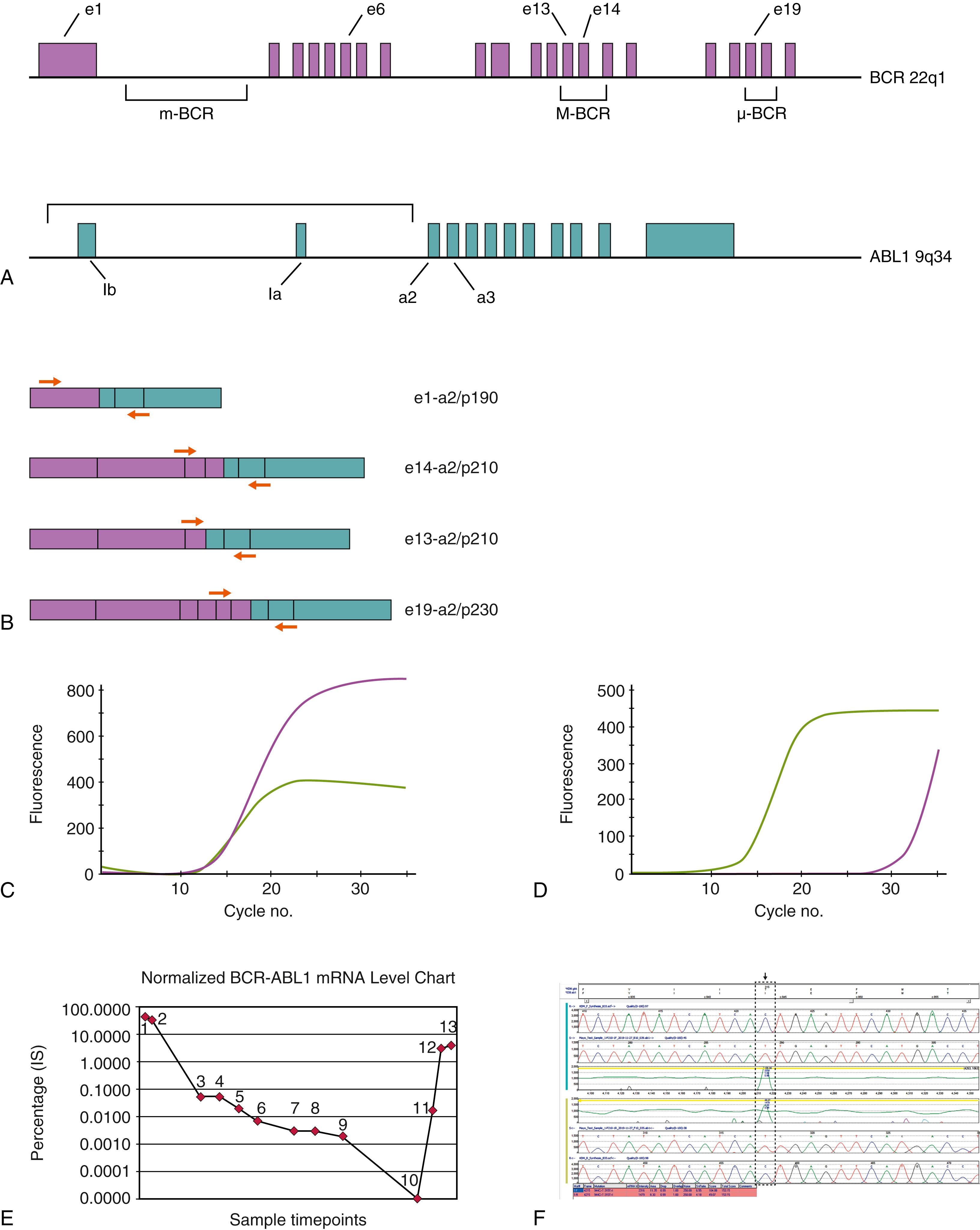 Figure 78.10, t(9;22)/ BCR-ABL1 abnormality in chronic myeloid leukemia (CML) and Ph+ B-lymphoblastic leukemia (B-LBL). A, Schematic of partial genomic organization of the BCR and ABL1 genes. Three major recurrent breakpoint regions are recognized in the BCR gene: the minor breakpoint cluster region (m-BCR), the major breakpoint cluster region (M-BCR), and the μ-BCR. The M-BCR is involved in essentially all cases of CML but also in approximately one third of cases of de novo BCR-ABL1 + B-lineage adult acute lymphoblastic leukemias (B-LBL) and a small subset of childhood cases. Breakpoints within the m-BCR are observed in the majority of pediatric and adult BCR-ABL1 + B-LBL. Breakpoints at the μ-BCR have been associated with rare cases of CML. For the ABL1 gene, genomic breakpoints are distributed throughout a large region 5′ of exon 2 (a2). B, Schematic representation of BCR-ABL1 chimeric mRNA transcripts arising from these various translocation genomic breakpoints. The exon junctions are indicated for these fusion transcripts, with the corresponding BCR-ABl1 oncoprotein product sizes shown in kilodaltons (e.g., e1-a2 and p190; e13/e14-a2 and p210; e19-a2 and p230). The orange arrows indicate relative positions of polymerase chain reaction (PCR) primers to detect these various forms in qualitative or quantitative reverse transcriptase PCR assays. C, Example of real-time quantitative PCR (RQ-PCR) monitoring of BCR-ABL1 mRNA in a patient with CML at diagnosis. The green curve represents ABL1 control amplification, and the purple curve is the detected BCR-ABL1 transcript. The percent BCR-ABL1 normalized to ABL1 is calculated and expressed on the International Scale (%IS); see text. D, RQ-PCR monitoring of a patient with CML on treatment with imatinib mesylate showing deep molecular response as evidenced by late occurrence of BCR-ABL1 target amplification relative to ABL1 control. E, Graphic of serial quantitative BCR-ABL1 normalized transcript levels (IS%) in a patient treated with imatinib. The major molecular response threshold is defined as 0.1% (IS). The patient results indicate a favorable response profile over time with relatively rapid attainment of deep molecular response. Loss of response is shown after measurement time-point 10, with a rapid rise in normalized BCR-ABL1 mRNA. F. BCR-ABL1 kinase domain mutation (KDM) analysis performed between time-points 11 and 12 for monitored patient in E . Sanger sequencing reveals the presence of an acquired p.Thr315Ile (T315I) mutation ( arrow and hatched box , C>T nucleotide substitution), which is relatively common and associated with resistance to most tyrosine kinase inhibitor agents used in CML therapy.