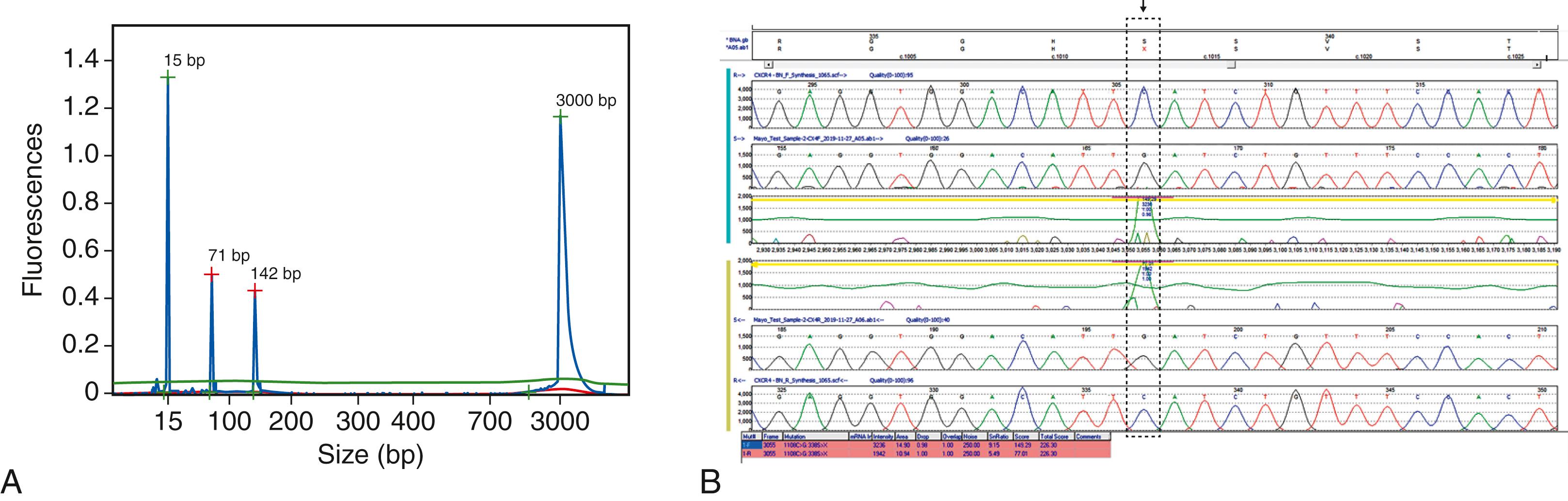 Figure 78.3, MYD88 p. Leu265Pro and related CXCR4 genetic alterations in lymphoplasmacytic lymphoma (LPL). A, A single reaction allele-specific polymerase chain reaction (AS-PCR) result detecting the presence of the MYD88 p.Leu265Pro (L265P) mutation. Outside PCR primers produce a larger amplicon (142 bp) that covers the target gene region. A second mutant allele-discriminating primer reaction is nested within the target region and produces a smaller amplicon (71 bp) but only in the presence of the single base substitution event causing the L265P change. If the MYD88 region is unaltered at this codon, then only the 142-bp product is observed. Electropherogram size standards are shown at either end of the display (15 and 3000 bp). The MYD88 L265P is highly associated with LPL (>90% of cases), although it can be seen in rare cases of splenic marginal zone lymphoma and chronic lymphocytic leukemia, as well as diffuse large B-cell lymphoma. B, Sanger sequencing showing detection of Ser338∗ abnormality in the CXCR4 gene ( arrow and hatched box , C>G nucleotide substitution), occurring in the same patient with MYD88 L265P shown in A . CXCR4 acquired alterations occur in a subset (∼30%) of MYD88 mutated LPL patients and are associated with poorer responses to ibrutinib therapy.