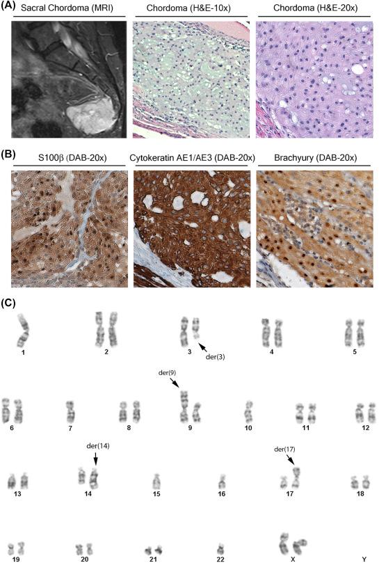 Figure 3.1, Chordoma immunohistochemistry and cytogenetics.