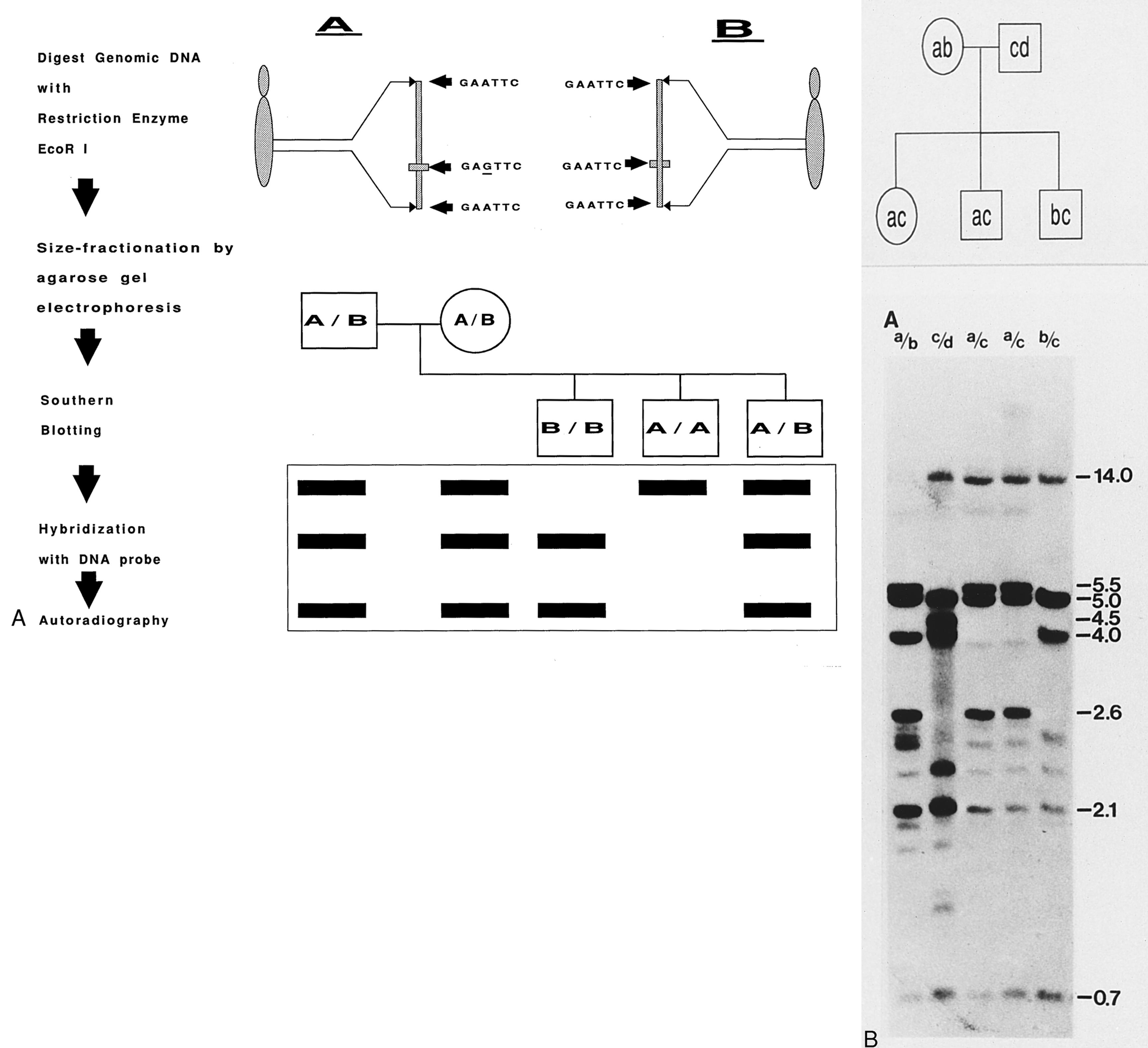 Fig. 2.2, Restriction fragment length polymorphism (RFLP). A, Schematic illustration. A and B represent two alleles that display a polymorphic site for the restriction enzyme EcoR I. EcoR I will cut deoxyribonucleic acid (DNA) with the sequence “GAATTC”; hence, allele B will be cut by EcoR I at three sites to generate two fragments of DNA, whereas allele A will be cut by EcoR I only twice and not at the site (indicated by horizontal bar) where nucleotide G (underlined) replaces the nucleotide A present in allele B. Following digestion, the DNA is size-fractionated by agarose gel electrophoresis and transferred to a membrane by Southern blot technique (see Fig. 2.1 for details). The membrane is then hybridized with a labeled DNA probe, which contains the entire sequence spanned by the three EcoR I sites. Radioautography of the membrane will detect the size of the DNA fragments generated by the restriction enzyme digestion. In this particular illustration, both parents are heterozygous and possess both A and B alleles. Matching the pattern of the DNA bands of the offspring with that of the parents will establish the inheritance pattern of the alleles. For example, if allele A represents the abnormal allele for an autosomal recessive disease, then examination of the Southern blot will establish that (from left to right) the first offspring (B/B) is homozygous for the normal allele, the second offspring (A/A) is homozygous for the abnormal allele, and the third offspring (A/B) is a carrier. B, RFLP analysis of the DQ-beta gene of the human leukocyte antigen (HLA) locus. Genomic DNA from the members of the indicated pedigree was digested with restriction enzyme Pst I, size-fractionated by agarose gel electrophoresis, and transferred to nitrocellulose membrane by Southern blot technique. The membrane was then hybridized with a complementary DNA probe specific for the DQ-beta gene; the excess probe was removed by washing at appropriate stringency and was analyzed by radioautography. The sizes of the DNA fragments (in kilobases, kb) are indicated on the right. The pedigree chart indicates the polymorphic alleles (a, b, c, d) and the bands on the Southern blot corresponding to these alleles (a [5.5 kb], b [5.0 kb], c [14.0 kb], d [4.5 kb]) indicate the inheritance pattern of these alleles.