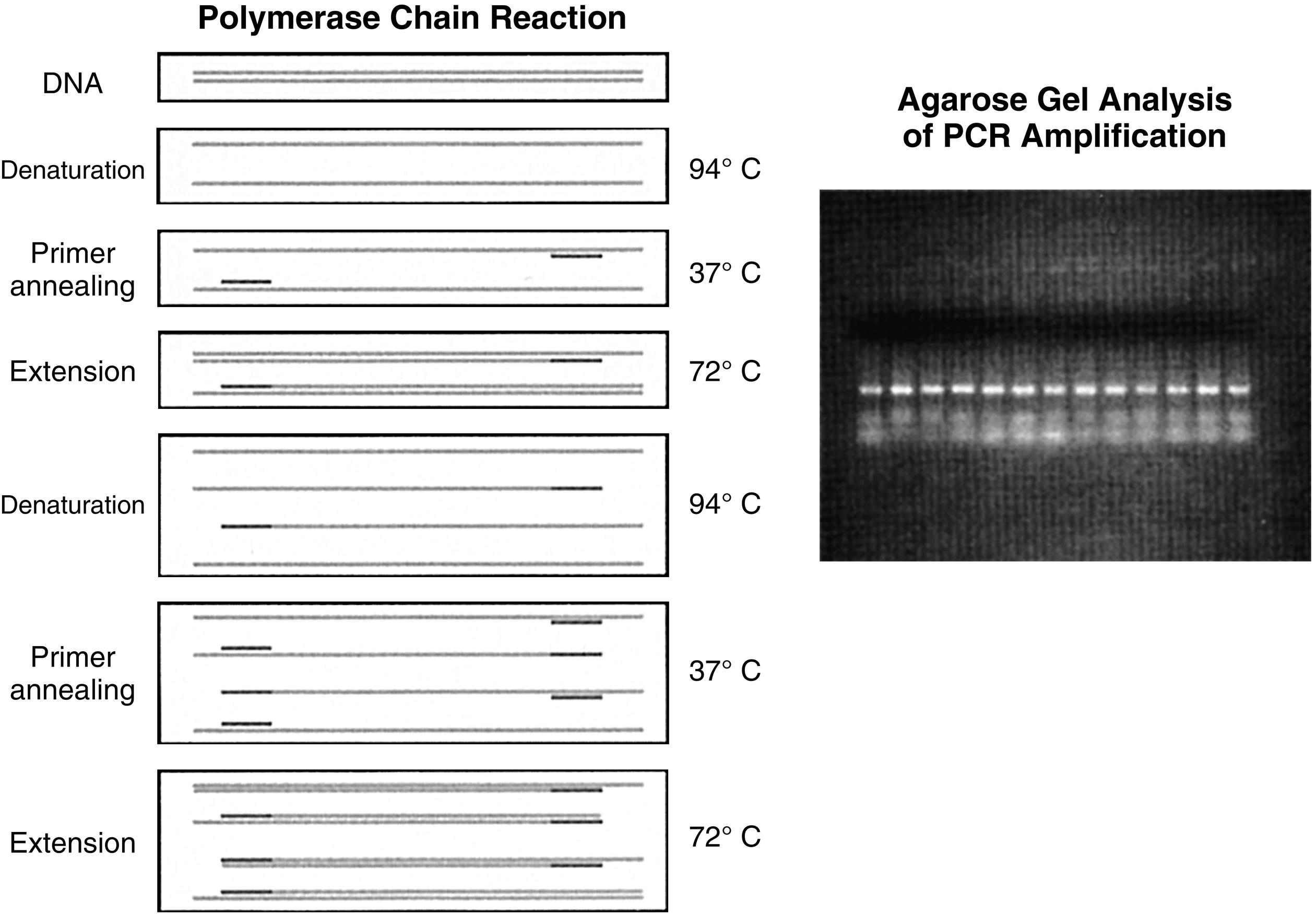 Fig. 2.3, Polymerase chain reaction (PCR). A pair of oligonucleotide primers (solid bars), complementary to sequences flanking a particular region of interest (shaded, stippled bars), are used to guide deoxyribonucleic acid (DNA) synthesis in opposite and overlapping directions. Repeated cycles of DNA denaturation, primer annealing, and DNA synthesis (primer extension) by DNA polymerase enzyme result in an exponential increase in the target DNA (i.e., the DNA sequence located between the two primers) such that this DNA segment can be amplified 1 × 106–7 times after 30 such cycles. The use of a thermostable DNA polymerase (i.e., Taq polymerase) allows for this procedure to be automated. Inset: The amplified DNA can be used for subsequent analysis (i.e., size-fractionation by agarose gel electrophoresis).