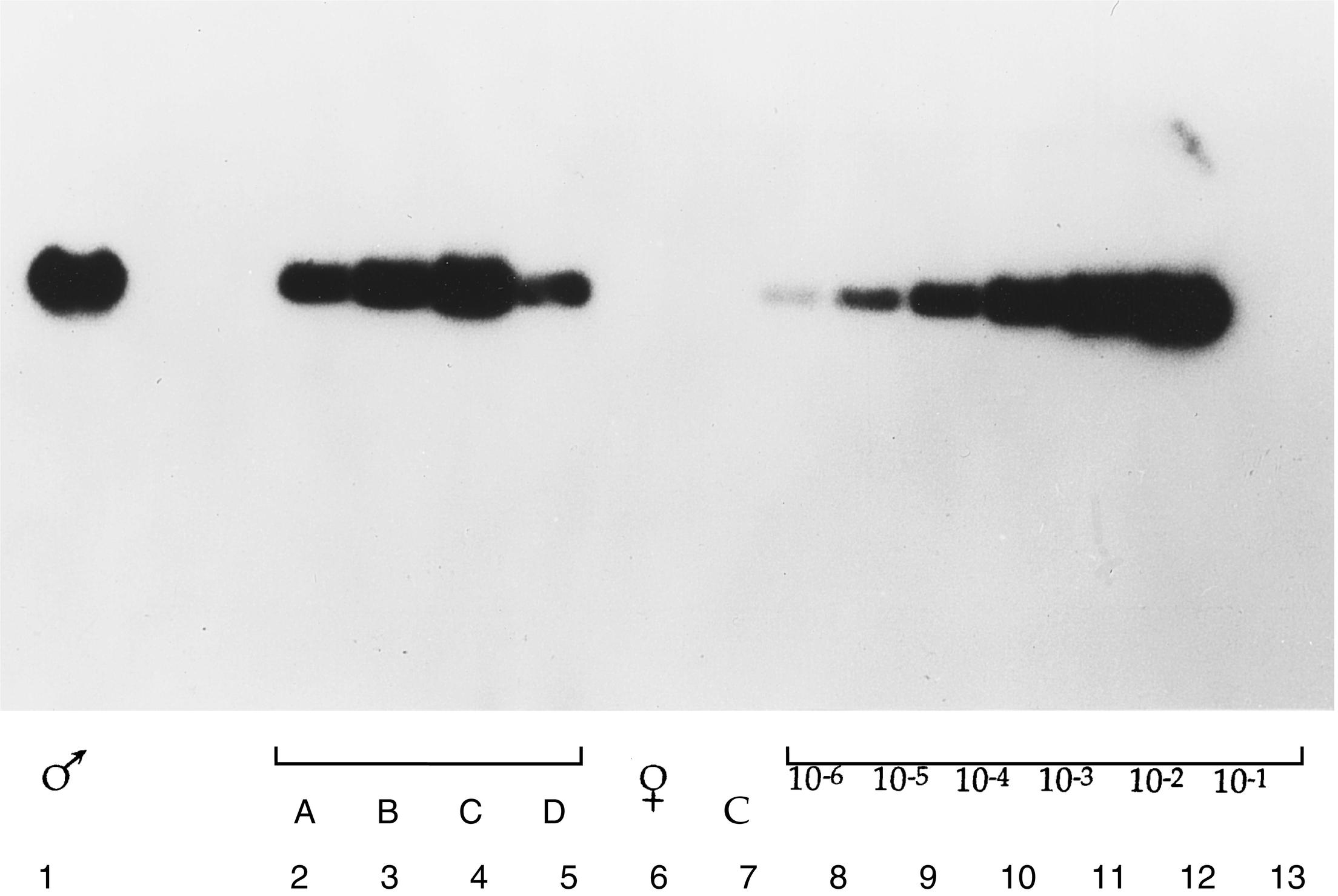 Fig. 2.4, Detection of SRY gene–specific sequence in Turner syndrome by polymerase chain reaction (PCR) amplification and Southern blot. SRY -specific primers were used in PCR to amplify deoxyribonucleic acid (DNA) from patients with 45X karyotype. The amplified DNA was size-fractionated by agarose gel-electrophoresis and transferred to membrane by Southern blotting. The membrane was then hybridized to labeled SRY -specific DNA and autoradiographed. From left to right: amplified male DNA (lane 1); amplified DNA from patients with 45X karyotype (lanes 2-5); amplified female DNA (lane 6); negative control with no DNA (lane 7); serial dilution of male DNA (lanes 8-13).