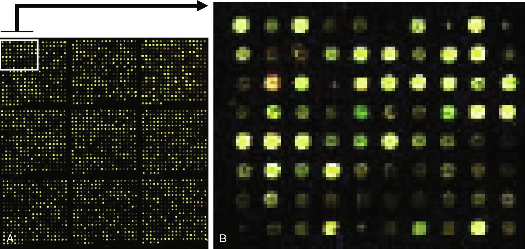 Fig. 2.7, A, Complementary deoxyribonucleic acid (cDNA) microarray, fluorescent labeled cDNA targets, adrenocorticotropic hormone (ACTH)-independent bilateral macronodular adrenal hyperplasia (Cy3), and ACTH-dependent hyperplasia (Cy5) were hybridized to glass slides containing genes involved in oncogenesis. Following laser activation of the fluorescent tags, fluorescent signals from each of the DNA “spots” are captured and subjected to analysis. B, Magnified view of the microarray platform displaying the fluorescent signals; green (Cy3) and red (Cy5) with yellow represent overlap of these two colors.