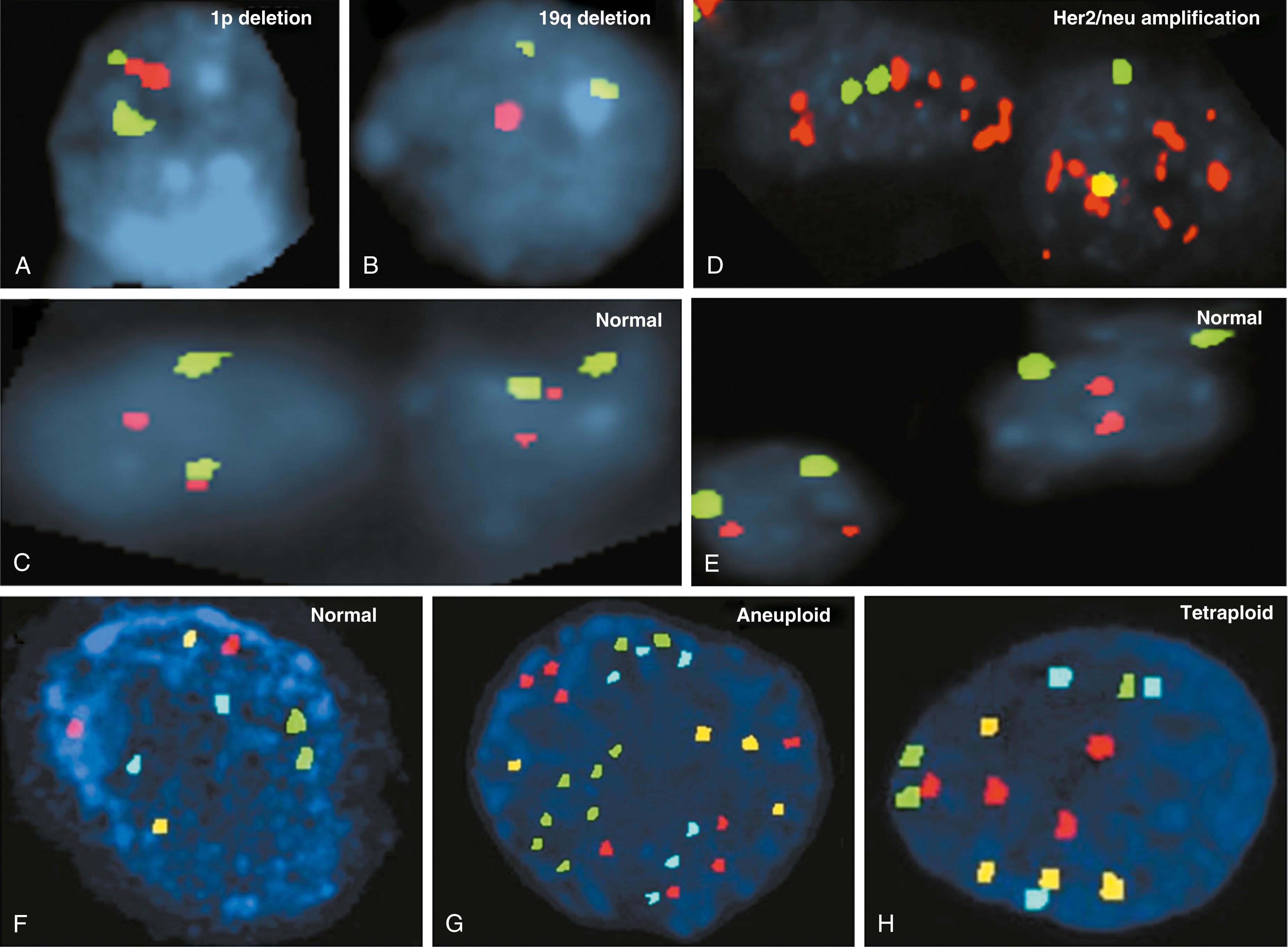 Figure 79.1, Examples of fluorescence in situ hybridization in cancer diagnosis. Oligodendroglioma with A, 1p and B, 19q deletions compared with C, normal cells. Green color in A, 1q probe; red color in A, 1p probe; green color in B, 19p probe; red color in B, 19q probe. D, Her2/neu amplification compared with E, normal cells. Green color: CEP17 probe. Red color: Her2/neu probe. UroVysion showing F, normal; G, aneuploid; and H, tetraploid cells. Aqua color: chromosome 17. Yellow (gold) color: 9p21 locus. Red color: chromosome 3. Green color: chromosome 7.