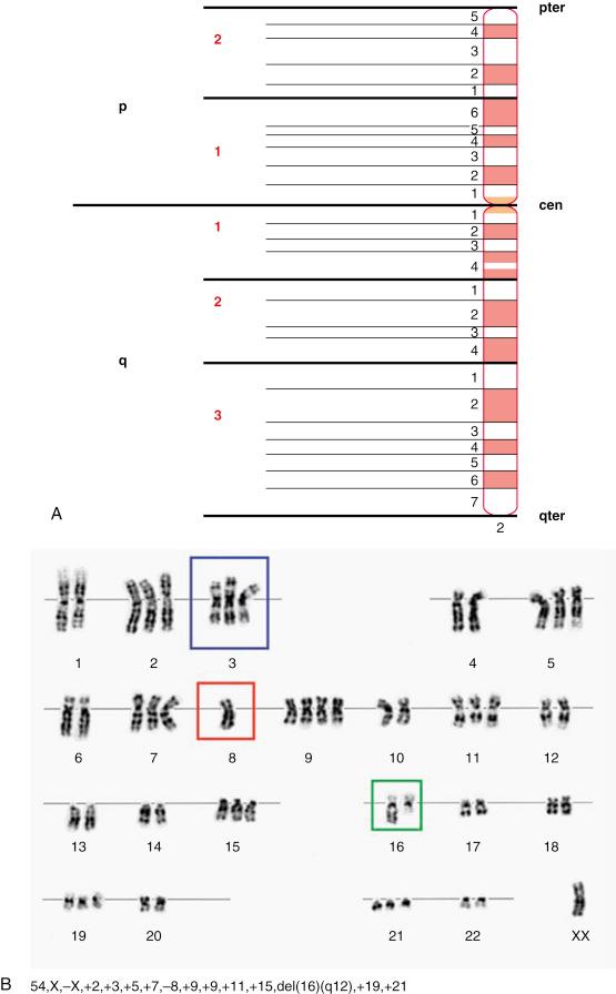 Fig. 4.3, A, Schematic (ideogram) of G-banded chromosome 2. The chromosome is divided at the centromere ( cen ) into a shorter, upper arm (the p arm) and a longer, lower arm (the q arm). Each arm is subdivided into regions (bold red numbers) , each of which contains a number of bands (black numbers) . Regions and bands are numbered from the centromere toward the ends of the p ( pter ) and q ( qter ) arms. B, Example of how karyotypes are written. The karyogram illustrates a tumor with a hyperdiploid (>46 chromosomes). The karyotype starts by showing the number of chromosomes (54), followed by the sex chromosome complement (only one X chromosome). Then, all clonal changes are described, starting with the sex chromosomes (XX or XY), followed by abnormalities of the autosomes (chromosomes 1-22) listed in numeric order. Examples of gained (+3), lost (−8), and structurally rearranged [del(16)(q12)], are indicated in blue, red, and green frames, respectively.