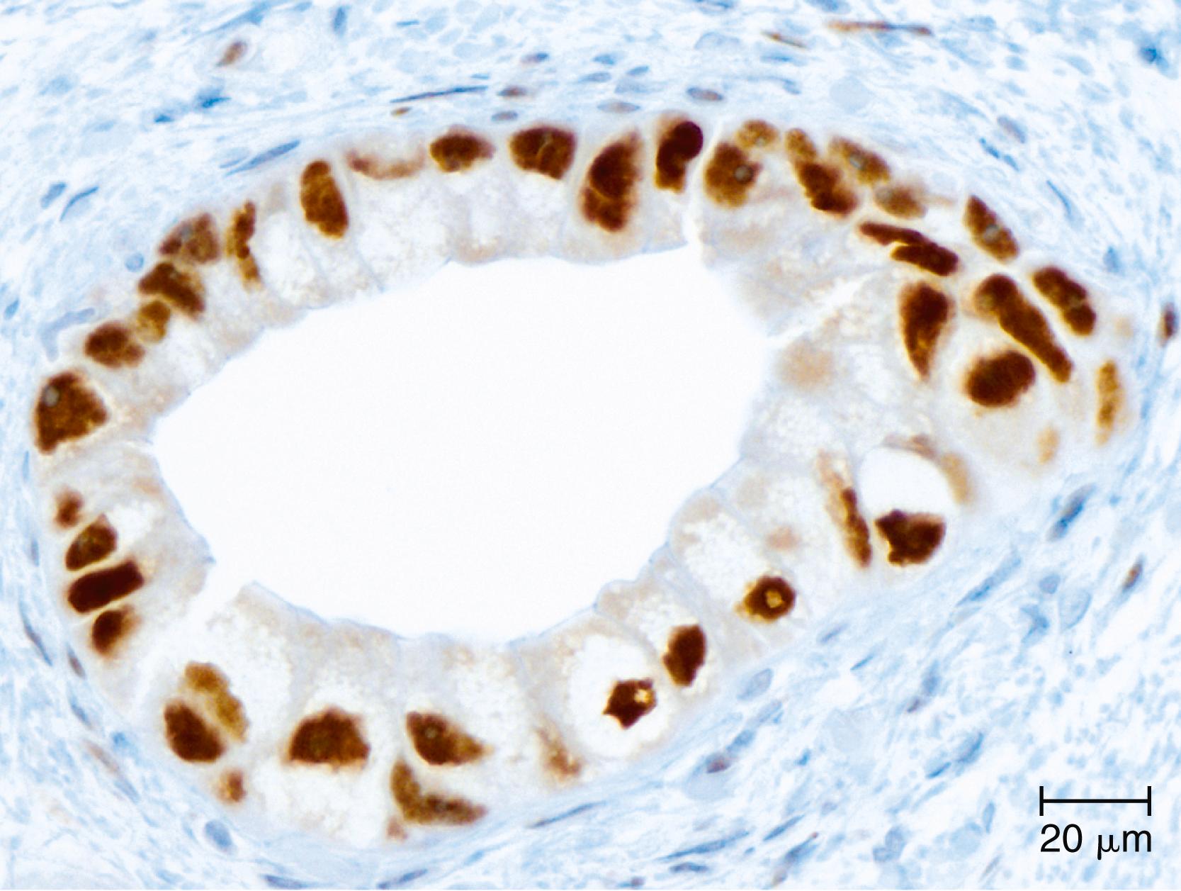 FIGURE 35.1, p53 immunohistochemistry in pancreatic ductal adenocarcinoma. Immunohistochemical labeling for p53 protein shows aberrant strong nuclear labeling in this neoplastic gland of pancreatic ductal adenocarcinoma, while the associated nonneoplastic stroma is negative.