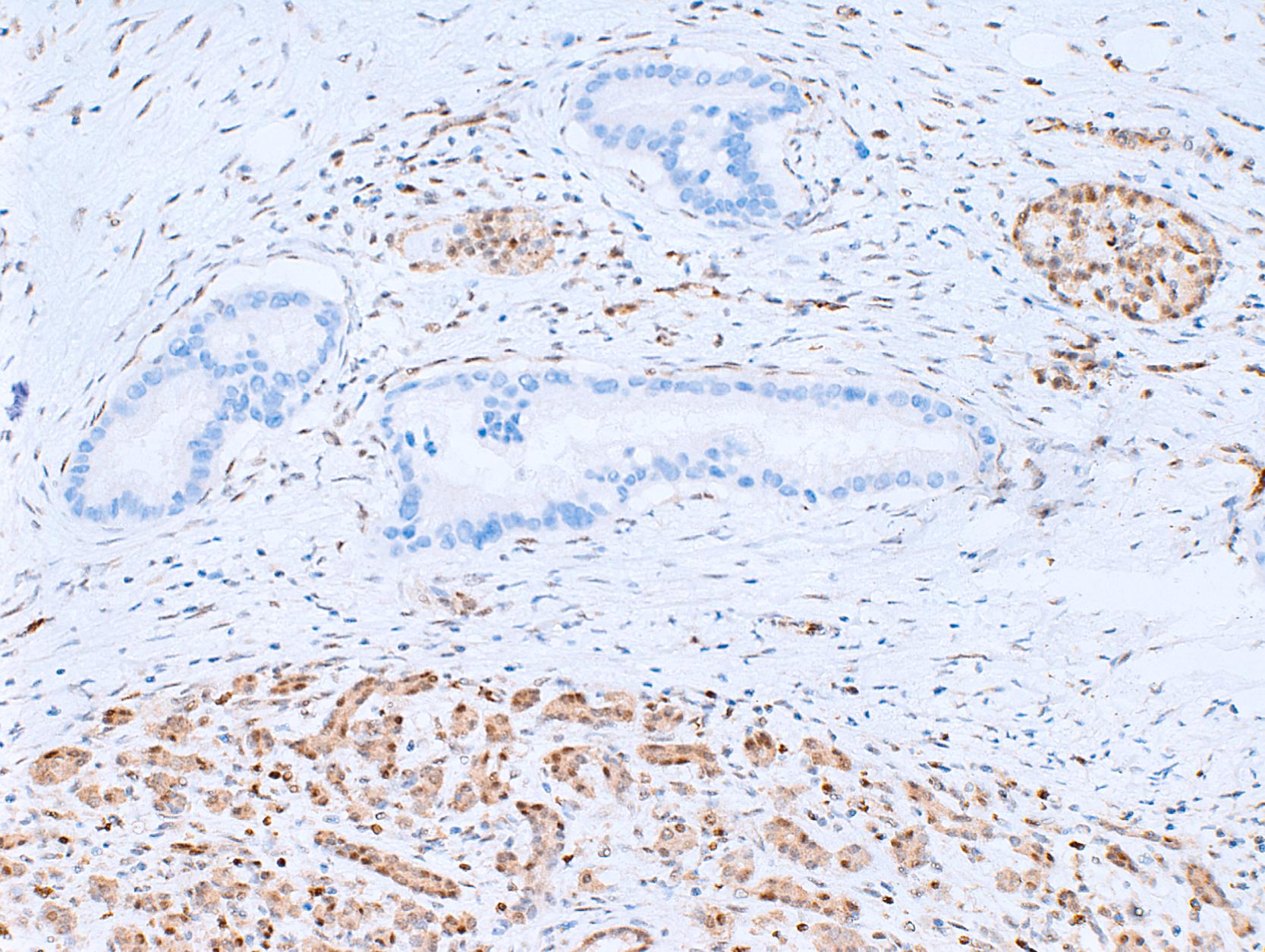 FIGURE 35.2, Smad4 immunohistochemistry in pancreatic ductal adenocarcinoma. Immunohistochemical labeling for Smad4 protein shows loss of expression in the neoplastic glands of pancreatic ductal adenocarcinoma, while the associated nonneoplastic stroma retains normal nuclear labeling.
