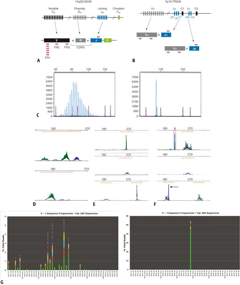 FIG. e24.3, Detection of clonality in lymphoid populations by polymerase chain reaction analysis of antigen receptor gene rearrangements.