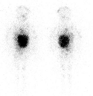 Figure 8.1, A case of a 2-year-old female child diagnosed of neuroblastoma showing an increased 131 I-MIBG uptake in its primary tumor on the left side of abdomen with increased tracer uptake in the left parietal bone suggestive of skeletal metastasis.