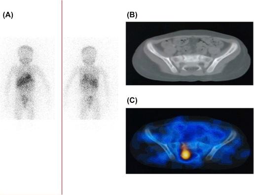 Figure 8.2, Diagnosed case of neuroblastoma in a 4-year-old-child showing suspicious 131 I-MIBG uptake in the lumbo-sacral region (A). The patient has further gone through SPECT/CT. The images show increased tracer uptake in right ala of sacrum, which confirmed the metastatic lesion (B, CT image; C, fused SPECT/CT image).