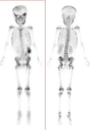 Figure 8.3, A diagnosed case of neuroblastoma in a 4-year-old female child showing increased 99 mTc-MDP accumulation in the right parietal bone, bilateral orbital bones, the mandible, and the bilateral pelvic bones suggestive of sites of skeletal metastasis. Also, there is an area of increased tracer uptake seen in the left lumbar region of the abdomen corresponding to the primary site of the tumor.