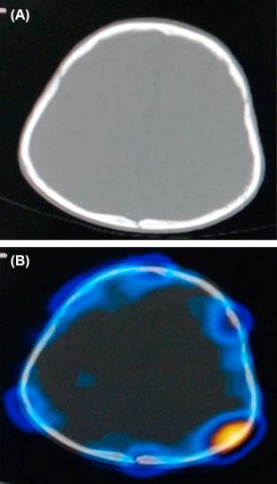Figure 8.4, 99 mTc-MDP SPECT/CT images of a 2-year-old female child showing increased tracer uptake in the left parietal bone suggestive of metastasis (A, CT image; B, fused SPECT/CT image).