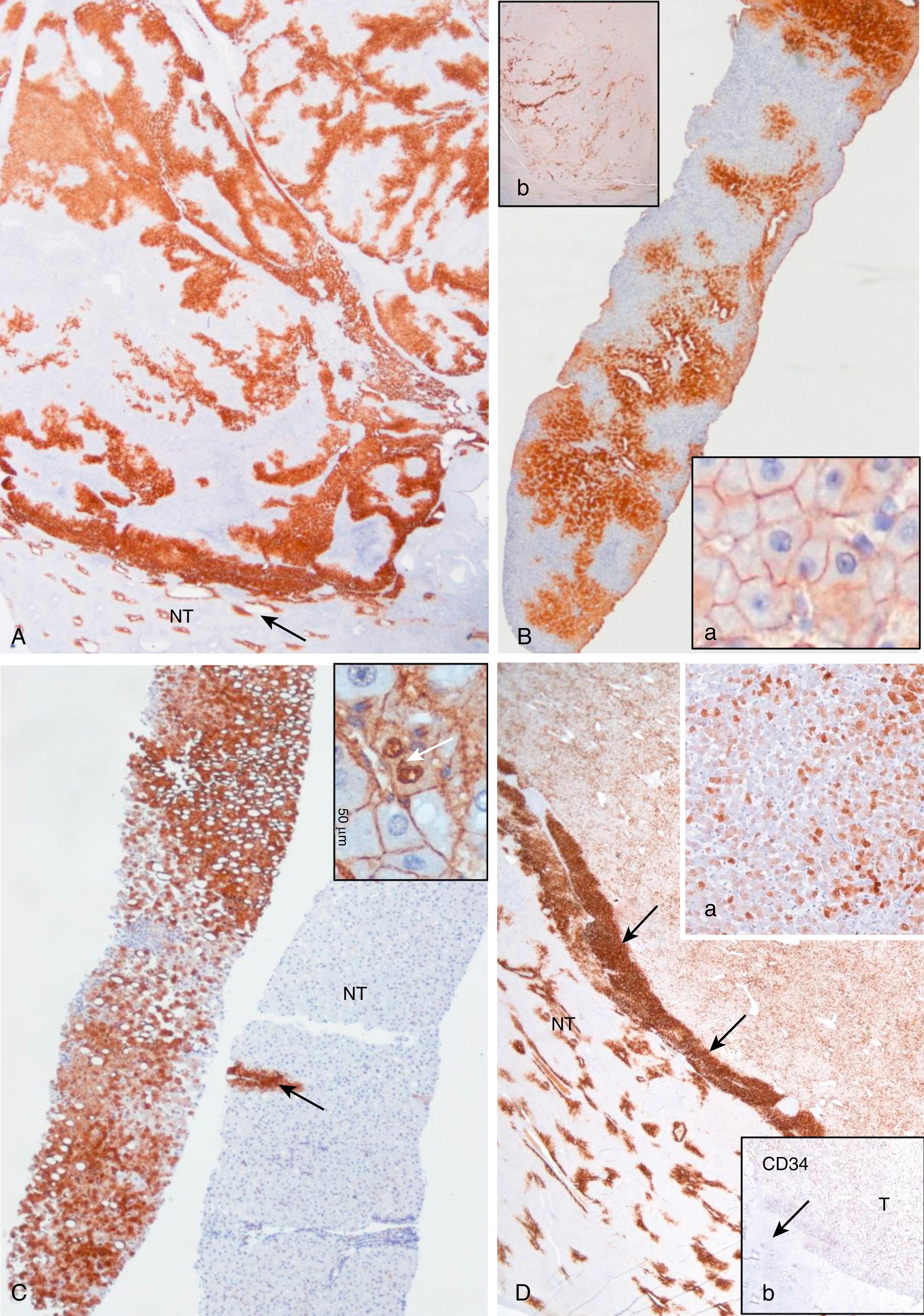 FIGURE 45.1, Characteristic patterns of glutamine synthetase (GS) immunostaining in focal nodular hyperplasia (FNH) (A, B), β-catenin–activated hepatocellular adenoma (HCA) (C, D), and nontumorous liver (A, C, D) . A,B, FNH. Large anastomosing GS-positive areas in a “map-like” pattern in resection specimen (A) and biopsy sample (B), contrasting with nontumorous liver (NT) , where GS expression is restricted to a few rows of perivenular hepatocytes (arrow) . Inset a , Normal membranous expression of β-catenin. Inset b , Little, nonspecific GS immunostaining in an FNH-like nodule occurring in vascular liver disease. C, b-HCA. Strong, diffuse expression of GS in a biopsy sample (C) and aberrant nuclear and cytoplasmic β-catenin staining (inset, arrow) , characteristic of a high level of β-catenin pathway activation (deletions or mutations in exon 3 non S45). D, Heterogenous expression of GS in a resection specimen, “starry-sky” pattern (inset a) , associated with a strong positive rim (arrows) adjacent to the nontumorous liver (NT) . Inset b , CD34 is diffusely expressed in endothelial cells of the tumor (T) except at the rim, where GS is strongly expressed (arrow) . These patterns are characteristic of b-HCA with exon 3 S45 mutation.