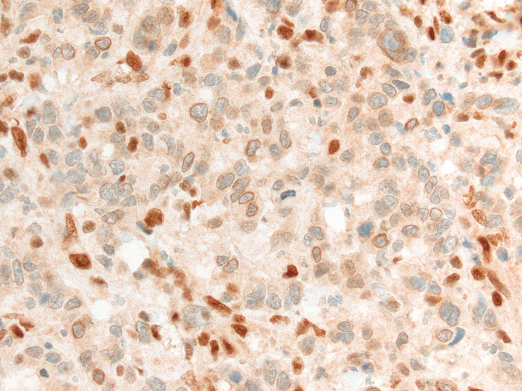 Figure 13.4, MLH1 immunostain with artifactual nuclear membrane staining in a cancer with MLH1 promoter hypermethylation. Intact protein expression is most reliably determined when diffuse nuclear staining is identified.