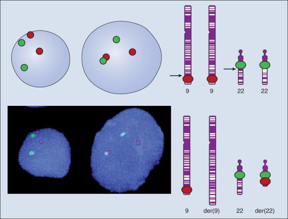 Figure 1.5, Detection of chromosomal translocations. Fluorescence in situ hybridization (FISH) technology uses a labeled DNA segment as a probe to search homologous sequences in interphase chromosomes for the t(9;22)(q34;q11) translocation, associated with chronic myeloid leukemia. On the left, patient nuclei were hybridized with probes for chromosome 9 (labeled with SpectrumRed fluorophore) and chromosome 22 (labeled with SpectrumGreen).