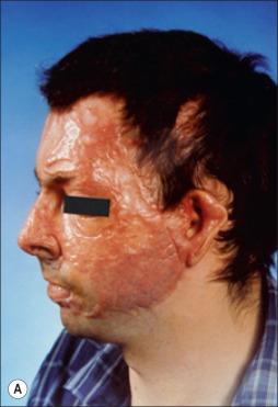 Fig. 45.1, Hypertrophic scarring in a 34-year-old white man, 8 months following a 60% total body surface area burn involving the face, upper extremities, and hands.