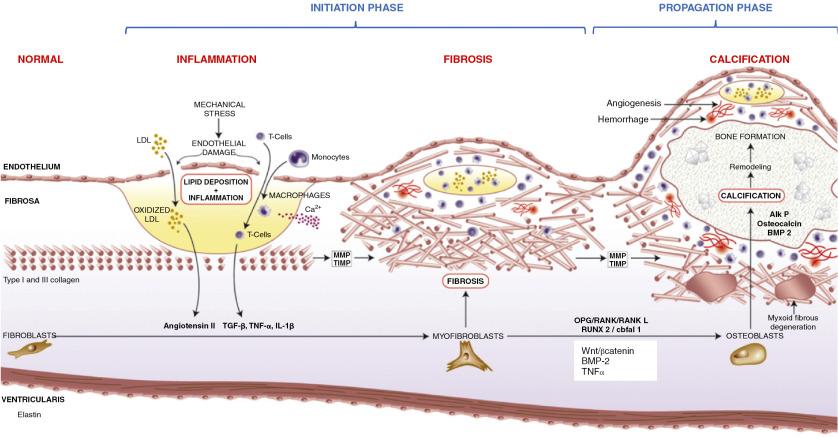 Fig. 3.2, Summary of the Pathology of Calcific Aortic Stenosis.