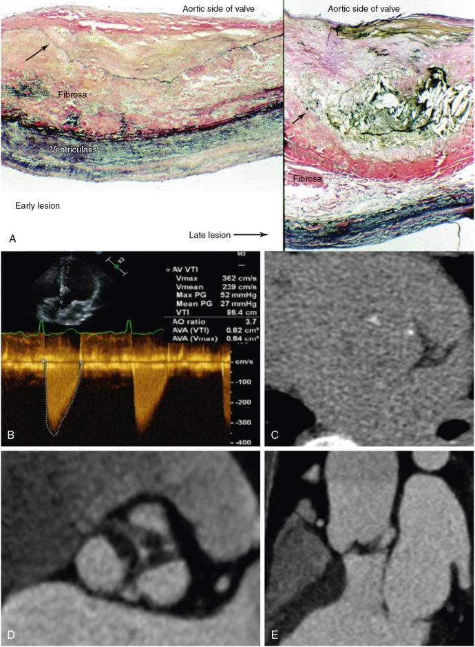 Fig. 3.3, Role of Valvular Fibrosis in Aortic Stenosis.