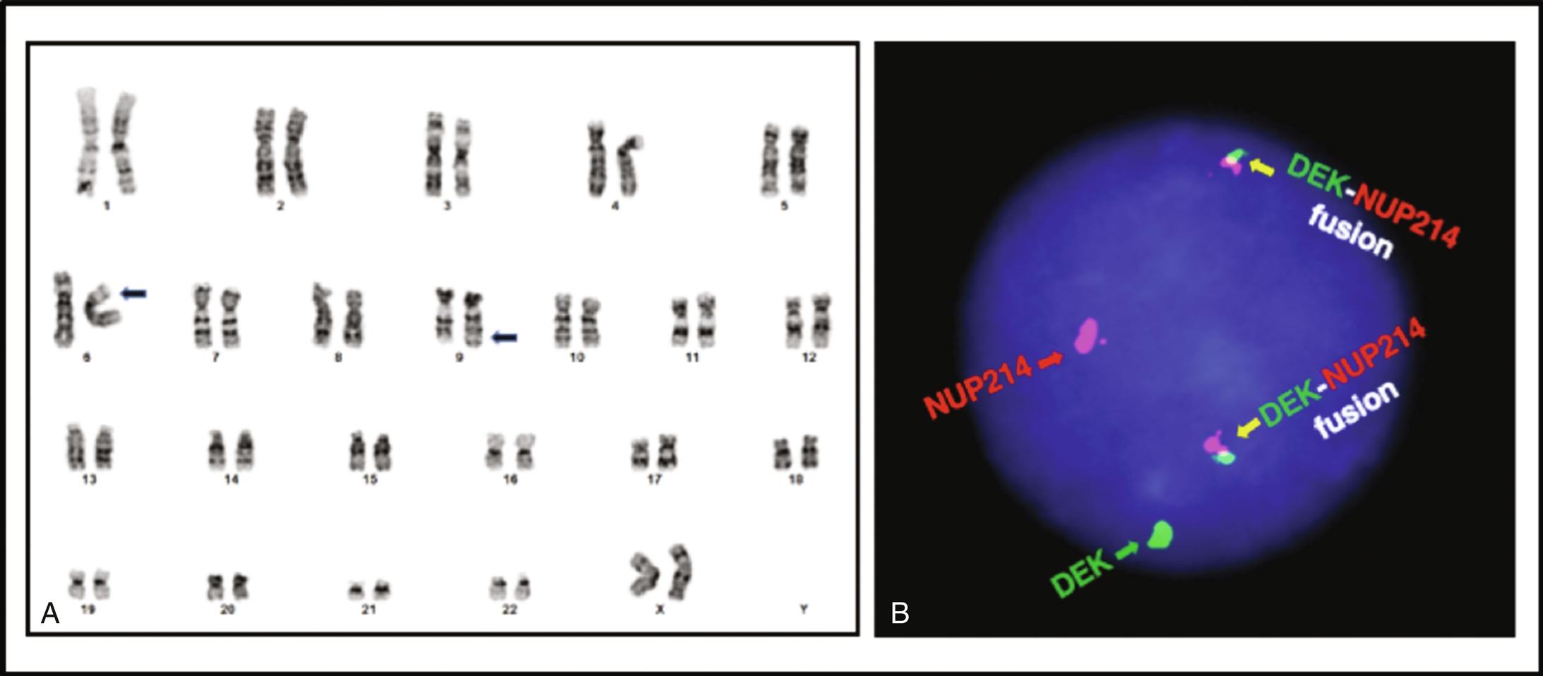 Figure 23.2, (A) Karyotype of an acute myeloid leukemia showing a t(6;9)(p22;q34) translocation ( filled arrows ). (B) Interphase fluorescence in situ hybridization (FISH) of the same specimen with a dual-color DEK-NUP214 fusion probe.