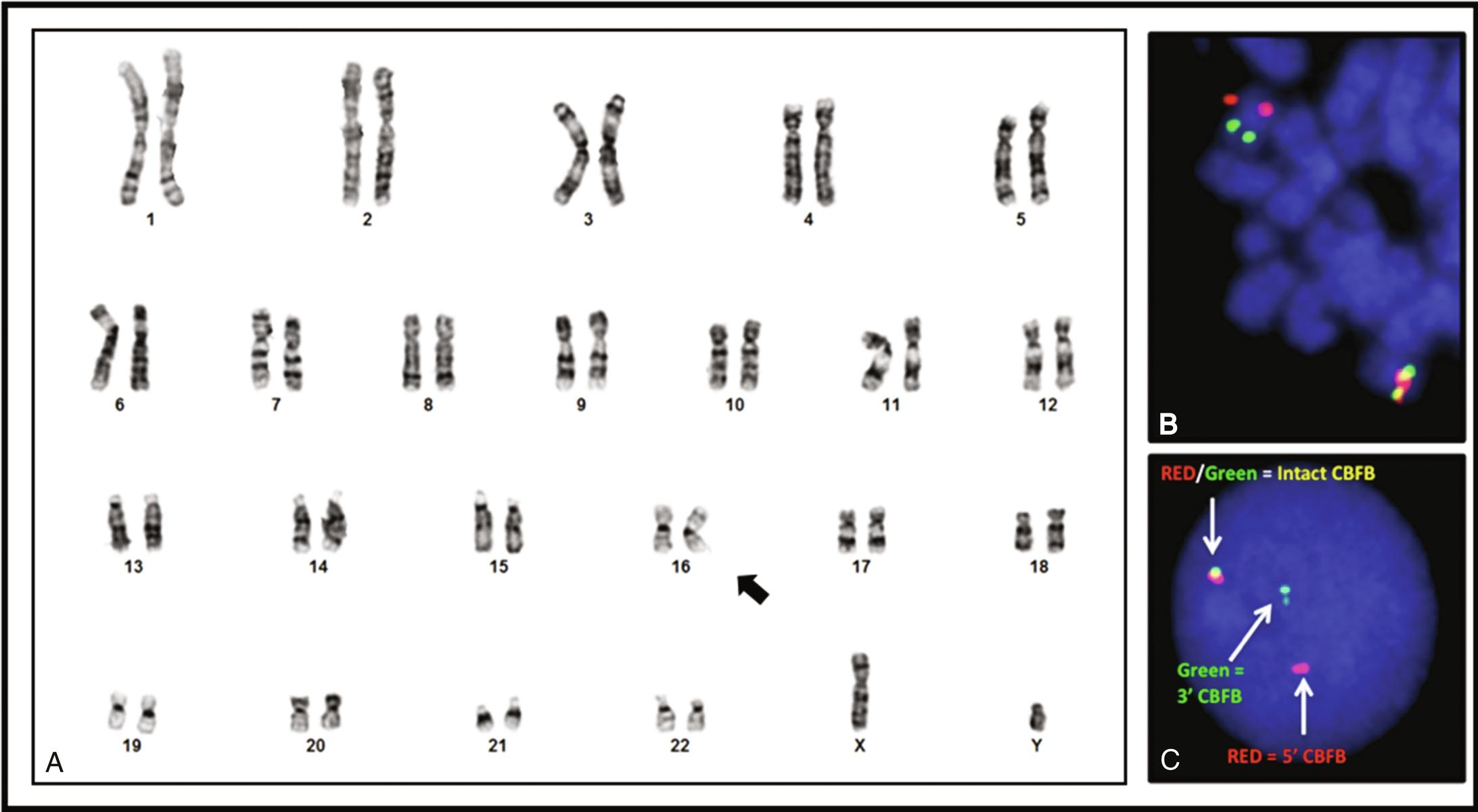 Figure 23.3, (A) Karyotype of an acute leukemia showing an inv(16(p13q22) ( filled arrow ). (B) Fluorescence in situ hybridization (FISH) of a metaphase with a CBFB break-apart probe, showing one fused (“normal”) signal in the lower right, and two split (rearranged) gray and bright white signals ( pink and green fluorescent probes, respectively) on the upper left. (C) Interphase FISH with the same probe showing one fused and one split signal, indicative of a CBFB rearrangement.