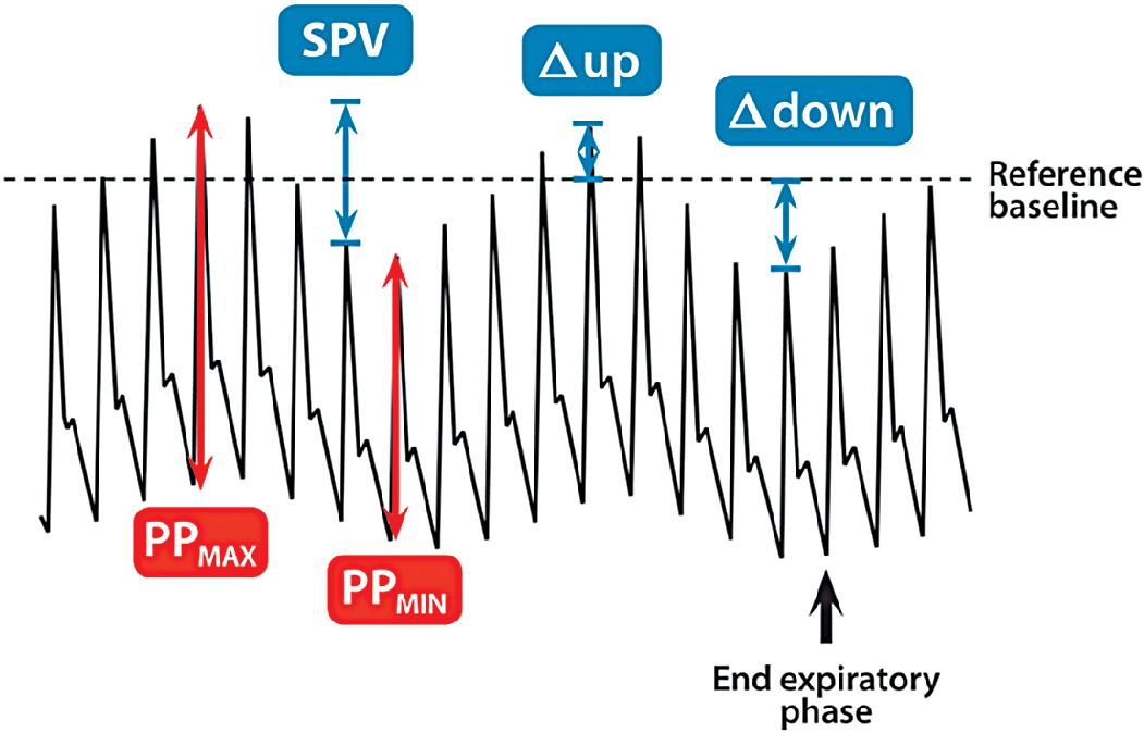Fig. 18.2, Mechanical Ventilation–Induced Variations in the Arterial Pressure Curve.
