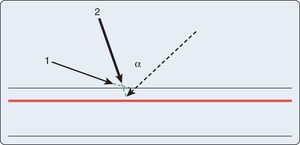 Fig. 10.2, Demonstration of the “triangulation” technique typically applied with ultrasound-guided (UG) venous and/or arterial cannulation in the transverse imaging approach. The echo imaging plane and the needle plane can be viewed as the two sides of a triangle that should meet and intersect at the depth of the structure (eg, radial artery [red line] ) for which cannulation is attempted. The experienced operator will change the angle (α) between the two planes (ultrasound and needle) and the distance (needle insertion site vs imaging plane), depending on the depth of the structure. To follow the needle tip in the transverse approach (vessel viewed in short axis), the echo plane or needle insertion angle has to be further adjusted from needle entry through the skin to the perforation of the vessel. A greater angle is used (echo plane angled toward the skin [1] ) to visualize the needle tip after it penetrates the skin, and then a more perpendicular angle relative to the skin is applied to see the needle tip entering the vessel lumen ( 2 ).