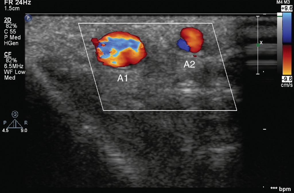 Fig. 10.3, A typical ultrasound image with color Doppler during short-axis (transverse) cannulation. Note the anatomic variation with a larger radial artery ( A1 ) next to a smaller artery ( A2 ) positioned laterally.