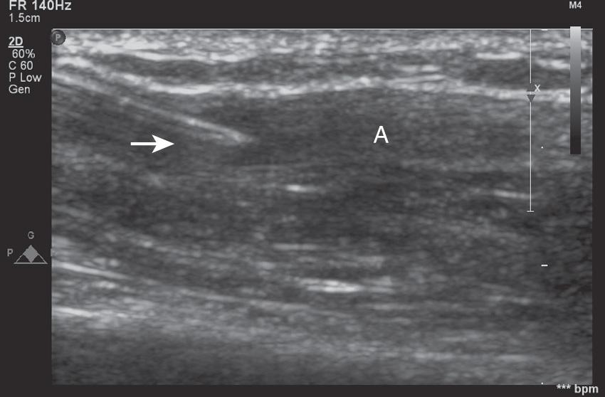 Fig. 10.4, Catheter entering the radial artery using the longitudinal (in-plane) approach.