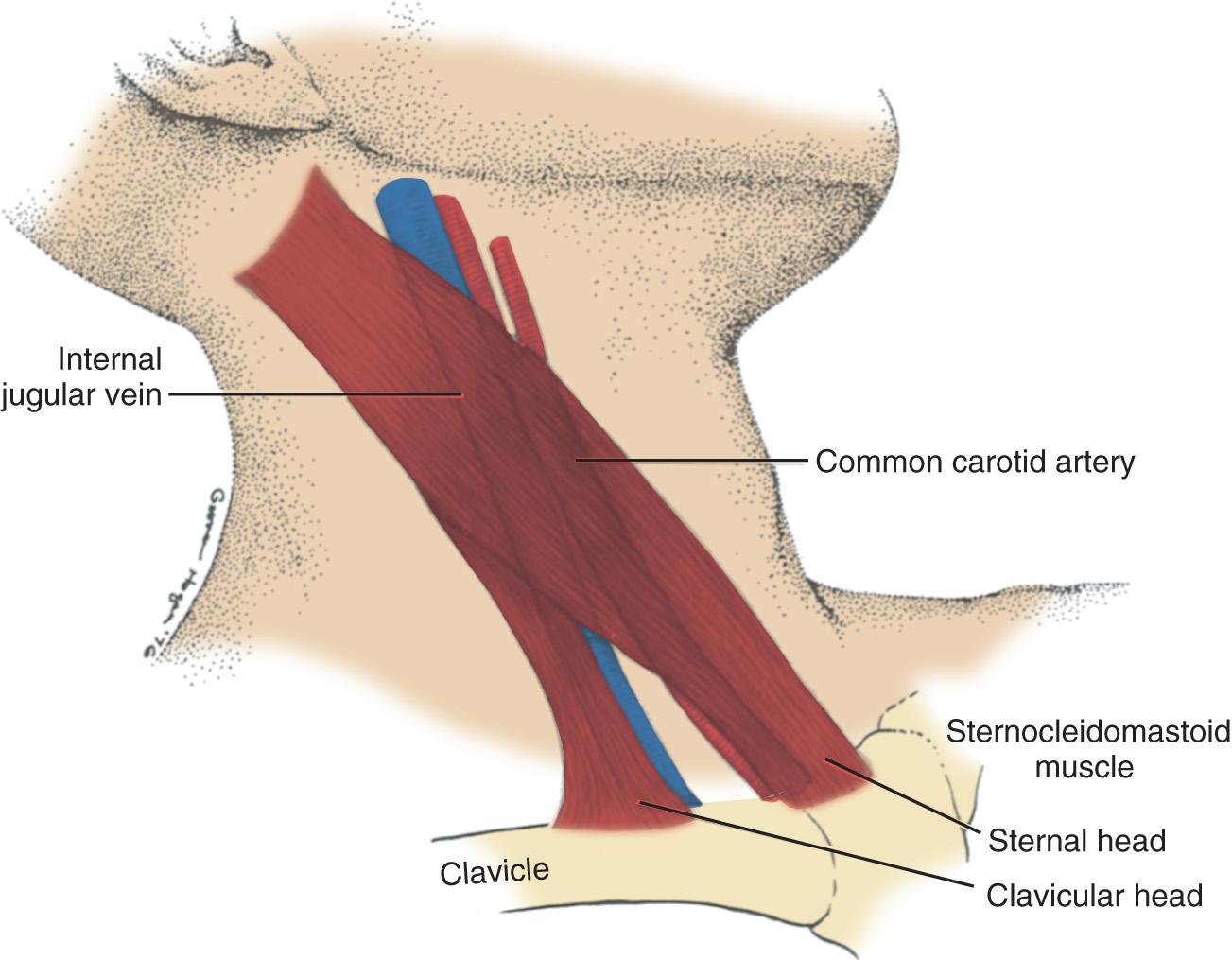 Fig. 10.5, The internal jugular vein is usually located deep to the medial border of the lateral head of the sternocleidomastoid muscle, just lateral to the carotid pulse.