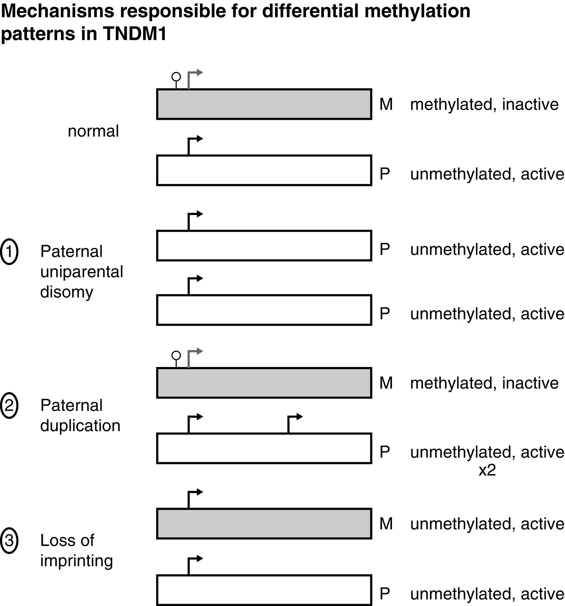 Fig. 10.3, Transient neonatal diabetes mellitus type 1 is caused by overexpression of imprinted genes on chromosome 6q24 ( PLAGL1 and HYMAI ). Normally the maternal allele remains methylated and inactive, whereas the paternal allele is unmethylated and active. The differential expression of these genes can occur by one of three mechanisms, as illustrated: (1) paternal uniparental disomy, where both alleles are of paternal origin; (2) paternal duplication, so that two active paternal alleles are expressed; (3) loss of imprinting (or “relaxation of imprinting”), whereby the maternal 6q24 allele is also expressed. See text for details.