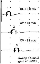 Figure 14.4, Nerve conduction studies for Case Example 14.2. The left ulnar nerve is stimulated at the wrist (waveform 1), below elbow (waveform 2), and above elbow (waveform 3) site with a recording electrode on the hypothenar muscles. Note the diffusely low-amplitude CMAPs with normal distal latency (DL) and proximal conduction velocities (CVs). CMAPs, compound muscle action potentials.